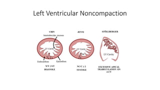 Left Ventricular Noncompaction
 
