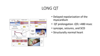 LONG QT
• Delayed repolarization of the
myocardium
• QT prolongation :QTc >480 msec
• syncope, seizures, and SCD
• Structurally normal heart
 