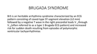 BRUGADA SYNDROME
BrS is an heritable arrhythmia syndrome characterized by an ECG
pattern consisting of coved-type ST-segment elevation (≥2 mm)
followed by a negative T wave in the right precordial leads V 1 through
V 3 (often referred to as a type 1 Brugada ECG pattern) and increased
risk for sudden death resulting from episodes of polymorphic
ventricular tachyarrhythmias
 