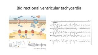 Bidirectional ventricular tachycardia
 