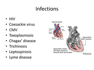 Infections
• HIV
• Coxsackie virus
• CMV
• Toxoplasmosis
• Chagas’ disease
• Trichinosis
• Leptospirosis
• Lyme disease
 