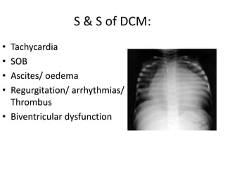 S & S of DCM:
• Tachycardia
• SOB
• Ascites/ oedema
• Regurgitation/ arrhythmias/
Thrombus
• Biventricular dysfunction
 