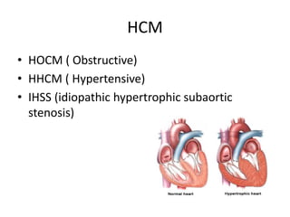 HCM
• HOCM ( Obstructive)
• HHCM ( Hypertensive)
• IHSS (idiopathic hypertrophic subaortic
stenosis)
 