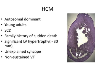 HCM
• Autosomal dominant
• Young adults
• SCD
• Family history of sudden death
• Significant LV hypertrophy(> 30
mm)
• Unexplained syncope
• Non-sustained VT
 