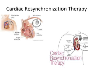 Cardiac Resynchronization Therapy
 
