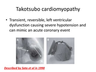 Takotsubo cardiomyopathy
• Transient, reversible, left ventricular
dysfunction causing severe hypotension and
can mimic an acute coronary event
Described by Sato et al in 1990
 