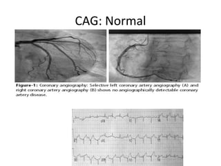 CAG: Normal
 