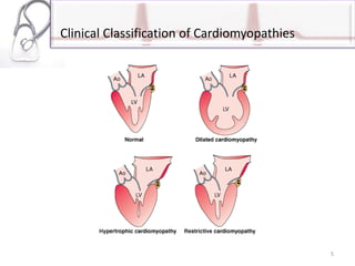 Clinical Classification of Cardiomyopathies
5
 