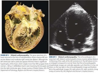 Cardiomyopathy | PPTX