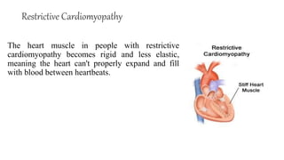 Restrictive Cardiomyopathy
The heart muscle in people with restrictive
cardiomyopathy becomes rigid and less elastic,
meaning the heart can't properly expand and fill
with blood between heartbeats.
 