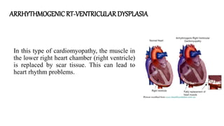 ARRHYTHMOGENIC RT-VENTRICULARDYSPLASIA
In this type of cardiomyopathy, the muscle in
the lower right heart chamber (right ventricle)
is replaced by scar tissue. This can lead to
heart rhythm problems.
 