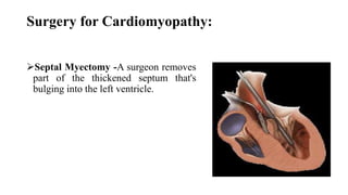 Surgery for Cardiomyopathy:
Septal Myectomy -A surgeon removes
part of the thickened septum that's
bulging into the left ventricle.
 