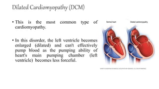 Dilated Cardiomyopathy (DCM)
• This is the most common type of
cardiomyopathy.
• In this disorder, the left ventricle becomes
enlarged (dilated) and can't effectively
pump blood as the pumping ability of
heart's main pumping chamber (left
ventricle) becomes less forceful.
 