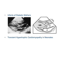 • Infants of Diabetic Mothers
• Transient Hypertrophic Cardiomyopathy in Neonates
 