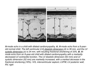 M-mode echo in a child with dilated cardiomyopathy. A, M-mode echo from a 9-year-
old normal child. The left ventricular (LV) diastolic dimension (d) is 36 mm, and the LV
systolic dimension (s) is 24 mm, with resulting fractional shortening of 33%. B, M-
mode echo from an 8-year-old child with dilated cardiomyopathy with a markedly
decreased LV contractile function. The LV diastolic dimension (62 mm) and LV
systolic dimension (52 mm) are markedly increased, with a marked decrease in the
fractional shortening (16%). IVS, interventricular septum; LVPW, LV posterior wall;
RV, right
 