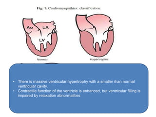 • There is massive ventricular hypertrophy with a smaller than normal
ventricular cavity.
• Contractile function of the ventricle is enhanced, but ventricular filling is
impaired by relaxation abnormalities
 