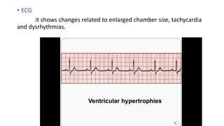 • ECG
it shows changes related to enlarged chamber size, tachycardia
and dysrhythmias.
 