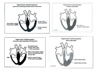 Cardiomyopathy - lecture.ppt