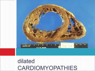 dilated
CARDIOMYOPATHIES
 