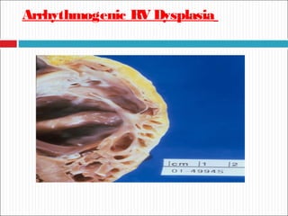 Arrhythmogenic RV Dysplasia
 