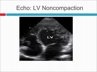 Echo: LV Noncompaction
 
