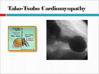 Tako-Tsubo Cardiomyopathy
 