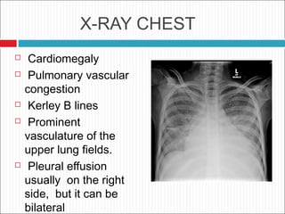 X-RAY CHEST
 Cardiomegaly
 Pulmonary vascular
congestion
 Kerley B lines
 Prominent
vasculature of the
upper lung fields.
 Pleural effusion
usually on the right
side, but it can be
bilateral
 