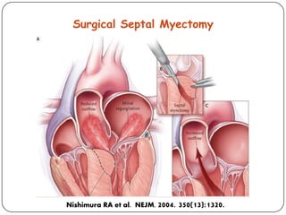Surgical Septal Myectomy
Nishimura RA et al. NEJM. 2004. 350(13):1320.
 