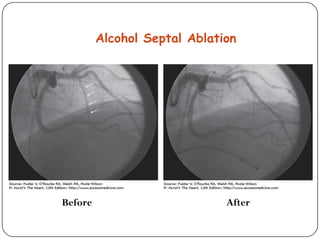 Alcohol Septal Ablation
Before After
 