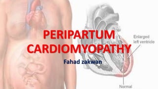 PERIPARTUM
CARDIOMYOPATHY
Fahad zakwan
 