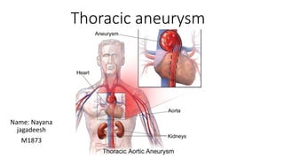 Thoracic aneurysm
Name: Nayana
jagadeesh
M1873
 