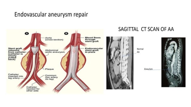 thoracic aneurysm | PPT