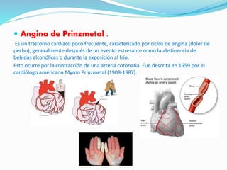  Angina de Prinzmetal .
Es un trastorno cardíaco poco frecuente, caracterizado por ciclos de angina (dolor de
pecho), generalmente después de un evento estresante como la abstinencia de
bebidas alcohólicas o durante la exposición al frío.
Esto ocurre por la contracción de una arteria coronaria. Fue descrita en 1959 por el
cardiólogo americano Myron Prinzmetal (1908-1987).
 
