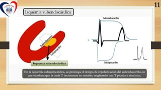 Isquemia subendocárdica
Isquemia subendocárdica
En la isquemia subendocárdica, se prolonga el tiempo de repolarización del...