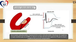 Lesión subendocárdica
Lesión subendocárdica
En la lesión subendocárdica, el potencial de acción subendocárdico disminuye d...