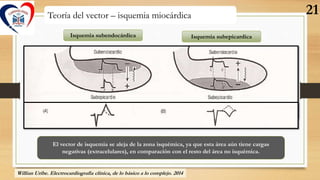 Teoría del vector – isquemia miocárdica
Isquemia subendocárdica Isquemia subepicardica
El vector de isquemia se aleja de l...
