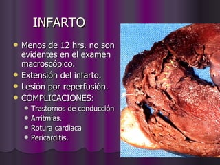 INFARTO Menos de 12 hrs. no son evidentes en el examen macroscópico.  Extensión del infarto. Lesión por reperfusión. COMPLICACIONES: Trastornos de conducción Arritmias. Rotura cardiaca Pericarditis. 