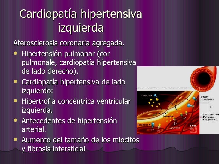 Cardiopatías