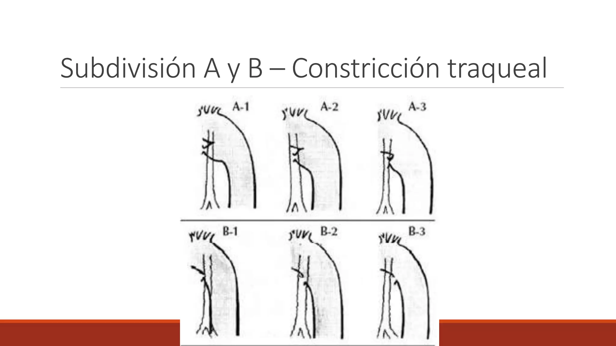 Subdivisión A y B – Constricción traqueal
 