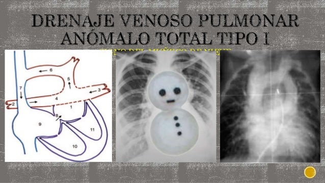 Cardiopatías congenitas. Signos clásicos radiológicos