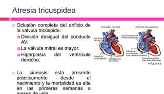 Atresia tricuspidea
 Oclusión completa del orificio de
la válvula tricúspide.
 División desigual del conducto
AV.
 La válvula mitral es mayor.
 Hiperplasia del ventrículo
derecho.
 La cianosis está presente
prácticamente desde el
nacimiento y la mortalidad es alta
en las primeras semanas o
 