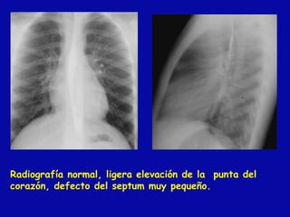 Radiografía normal, ligera elevación de la punta del
corazón, defecto del septum muy pequeño.
 