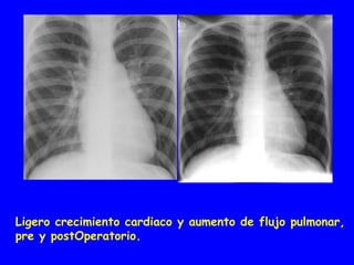 Ligero crecimiento cardiaco y aumento de flujo pulmonar,
pre y postOperatorio.
 