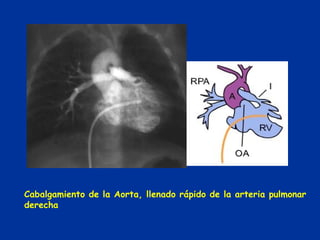Cabalgamiento de la Aorta, llenado rápido de la arteria pulmonar
derecha
 