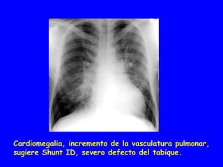 Cardiomegalia, incremento de la vasculatura pulmonar,
sugiere Shunt ID, severo defecto del tabique.
 