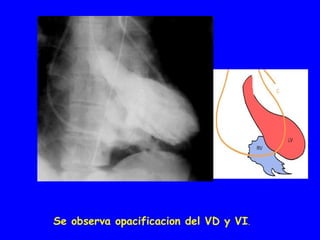 Se observa opacificacion del VD y VI.
 