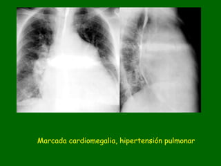 Marcada cardiomegalia, hipertensión pulmonar
 