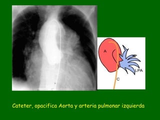 Cateter, opacifica Aorta y arteria pulmonar izquierda
 