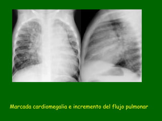 Marcada cardiomegalia e incremento del flujo pulmonar
 