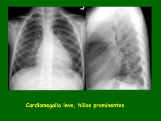 Cardiomegalia leve, hilios prominentes
 